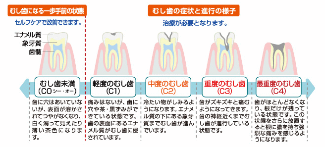 むし歯の進行